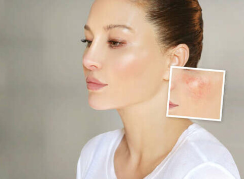 Fotorejuvenizácia - fotoomladenie tváre, krku a dekoltu pomocou intenzivného pulzného svetla IPL