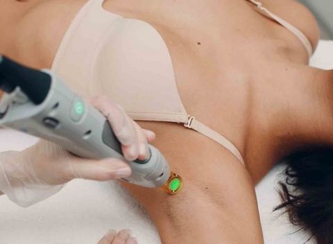 Laserová epilácia – najúčinnejšia metóda trvalého odstraňovania chĺpkov.