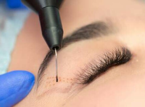 Plazmalifting očných viečok v centre tvárovej kondície DIAMONDFACE