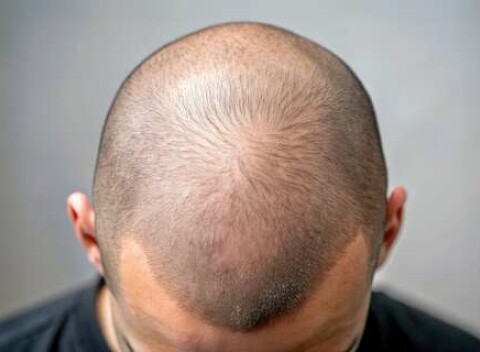 Tetovanie vlasov v štúdiu Story ink - rýchle riešenie straty vlasov, ktoré vyzerá prirodzene