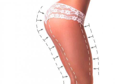 Dajte padáka diétam Nechirurgické riešenie celulitídy s LPG kúrou