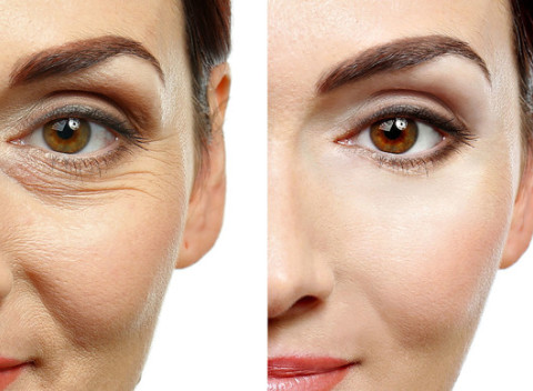 Fibroblast - neinvazívny lifting očných viečok a vrások v IM STUDIO.