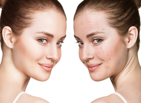 PRX-T®33 terapia – inovatívna technológia remodelácie a revitalizácie pokožky bez injekčných techník.