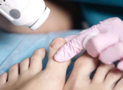 Laserové ošetrenie plesňového ochorenia nechtov. Rýchla a bezbolestná liečba zažltnutých, zhrubnutých a boľavých nechtov. 